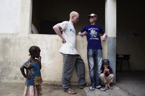 La grande peur des albinos