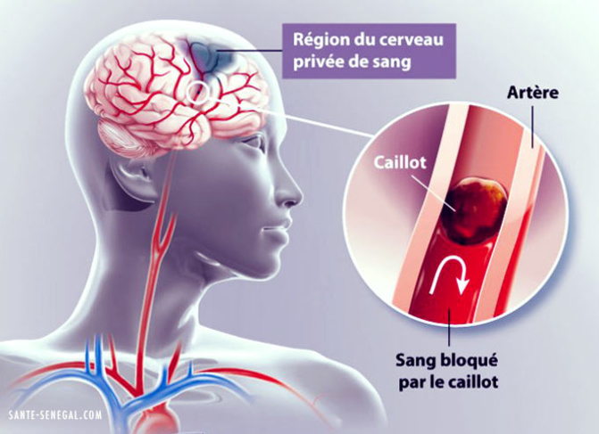 Prise en charge de l’Avc au Sénégal : La forte fréquence de décès s’explique par le manque de structures