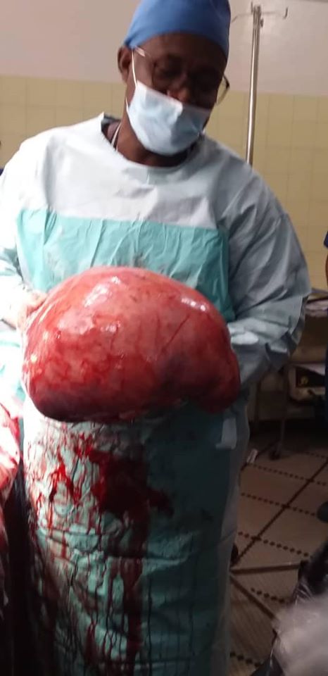 Photos: un fibrome de dix kilogrammes retiré d'une dame à Thiès