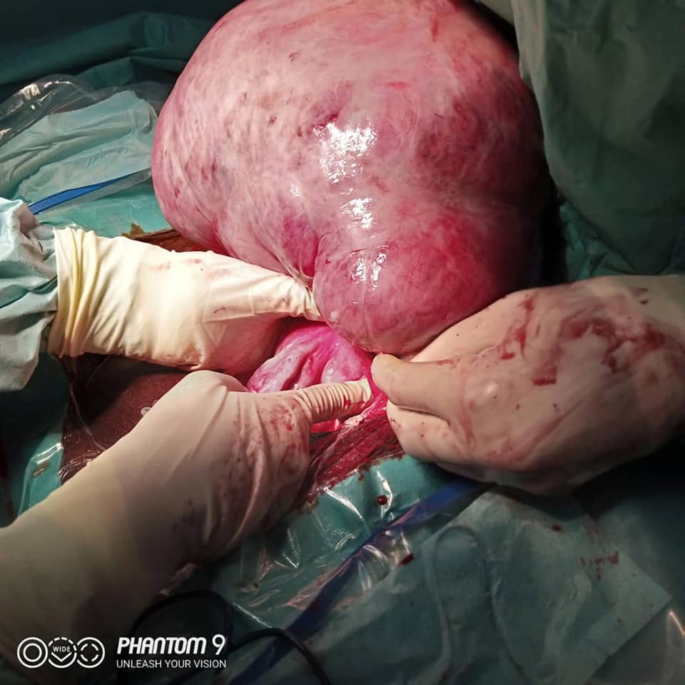 Photos: un fibrome de dix kilogrammes retiré d'une dame à Thiès