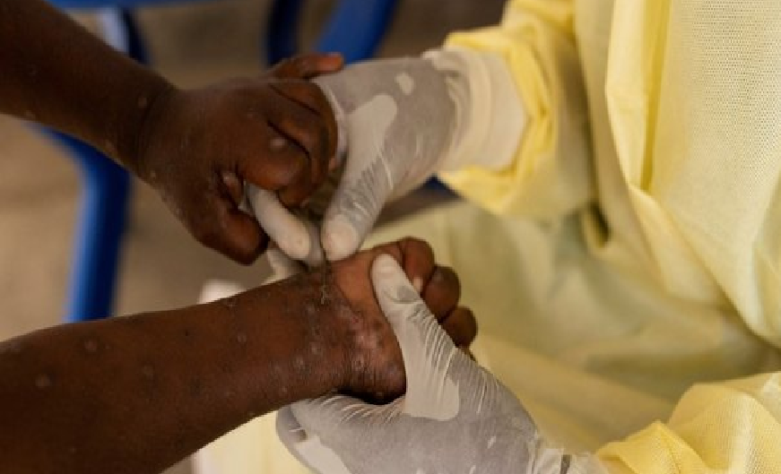 Variole du singe : Vers un vaccin pour les pays à risque, annonce l’Institut Pasteur de Dakar