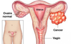 Vous doublez votre risque de cancer des ovaires en faisant ceci