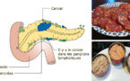 14 aliments cancérigènes que vous ne devriez plus jamais mettre dans votre bouche